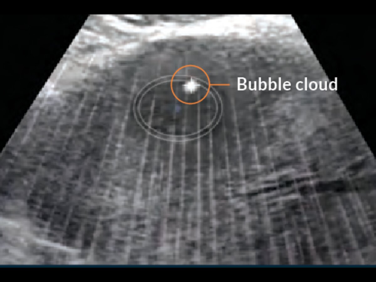 Histotripsy bubble cloud