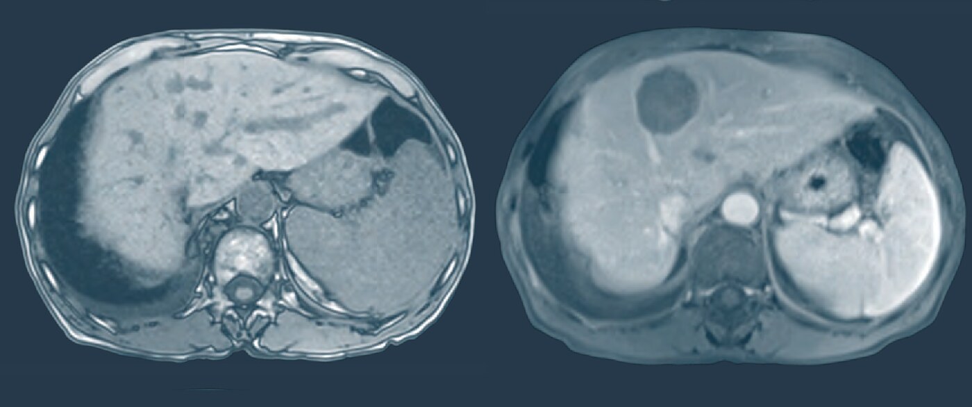 Histotripsy mri compare